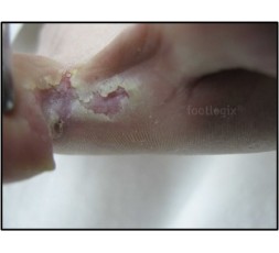 Le 18 novembre 2023 - Les atteintes dermatologiques du pied - Le matériel et les produits pour soulager le patient - Charleroi