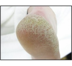 Le 18 novembre 2023 - Les atteintes dermatologiques du pied - Le matériel et les produits pour soulager le patient - Charleroi