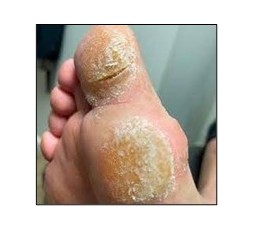 Le 18 novembre 2024 - Les atteintes dermatologiques du pied - Le matériel et les produits pour soulager le patient - Pecq