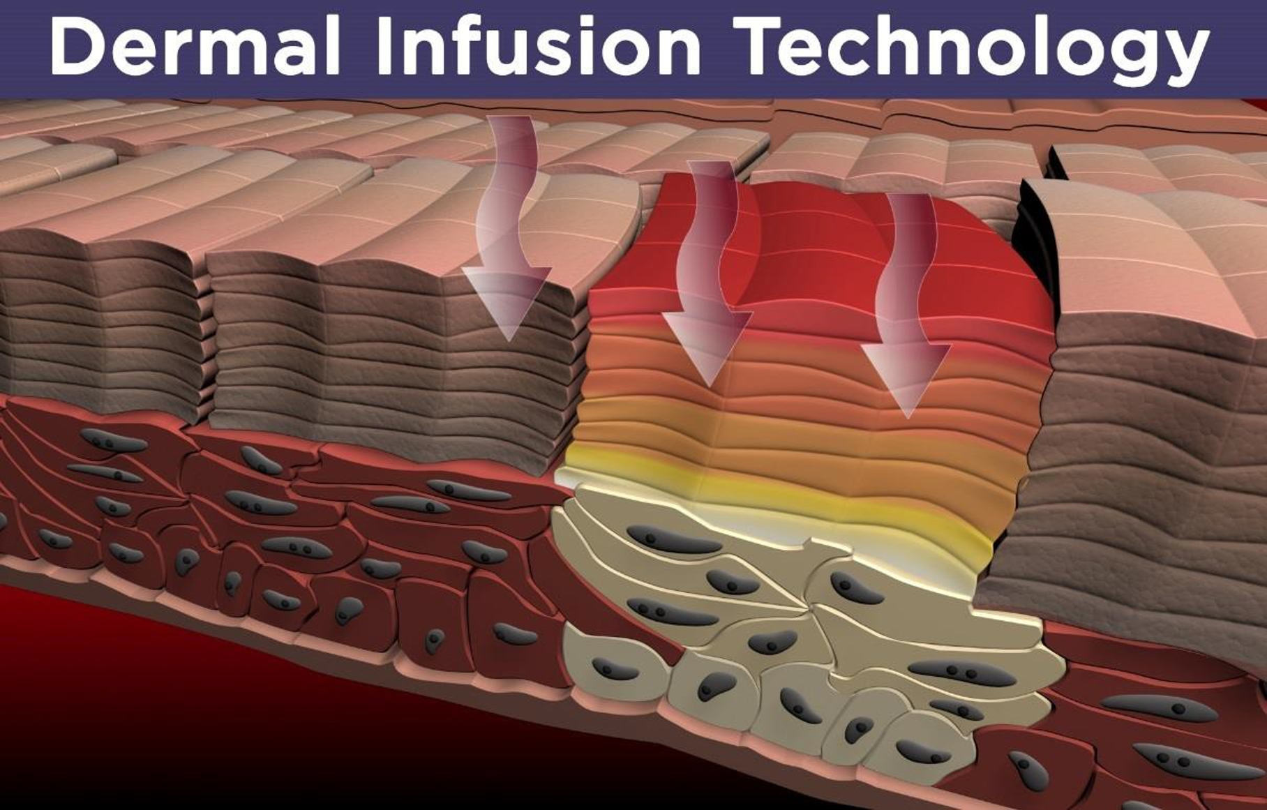 Dermal Infusion Technology